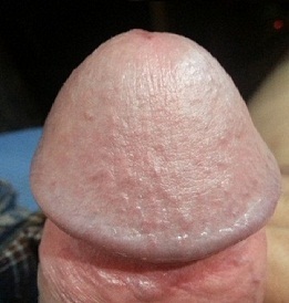 Photo of enlarged bladder penis