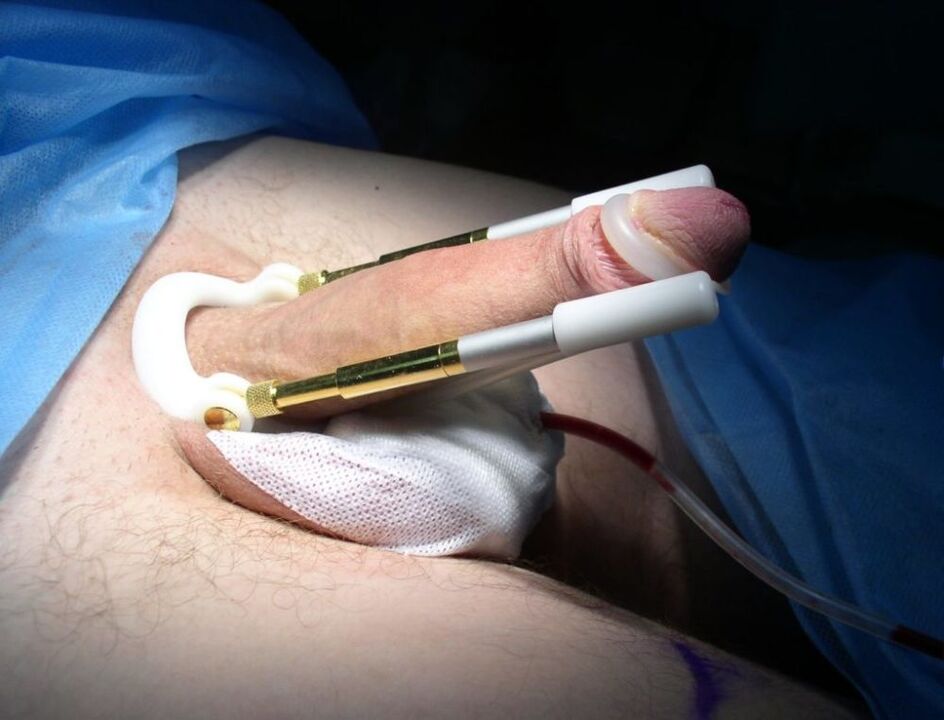 Prolonged after penis enlargement surgery