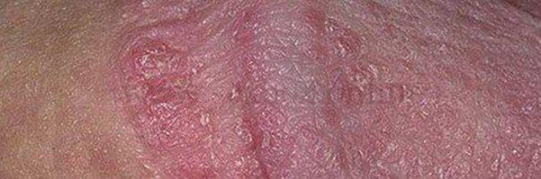 Dry skin and ulcers on the head of the penis after using baking soda