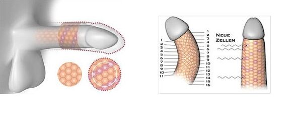 The result of the operation for penis enlargement