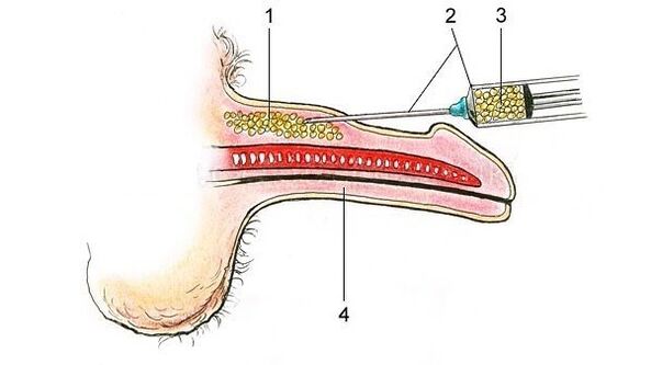 Hyaluronic acid injection to thicken the penis